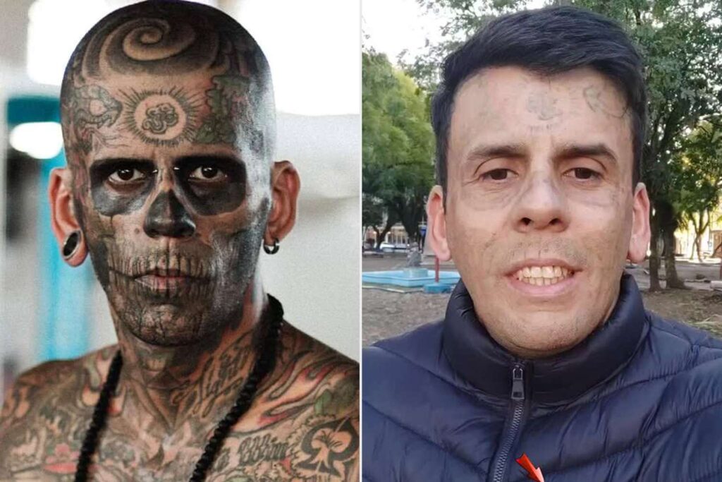Após conversão, homem mais tatuado do país remove pinturas